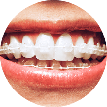 Braces1
