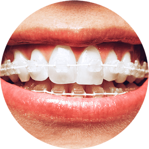 Braces1_compressed