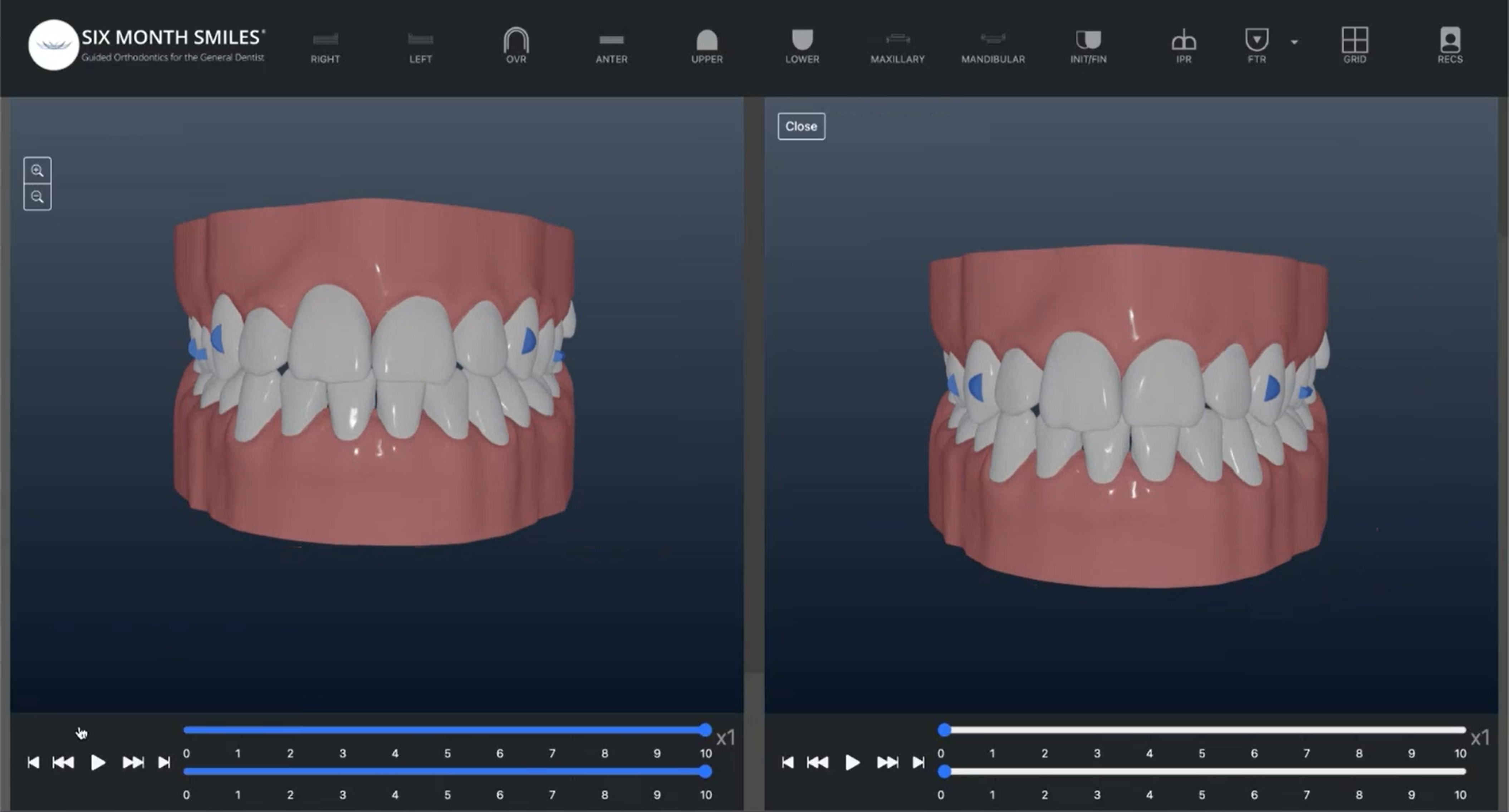 6MS Confidex Aligners