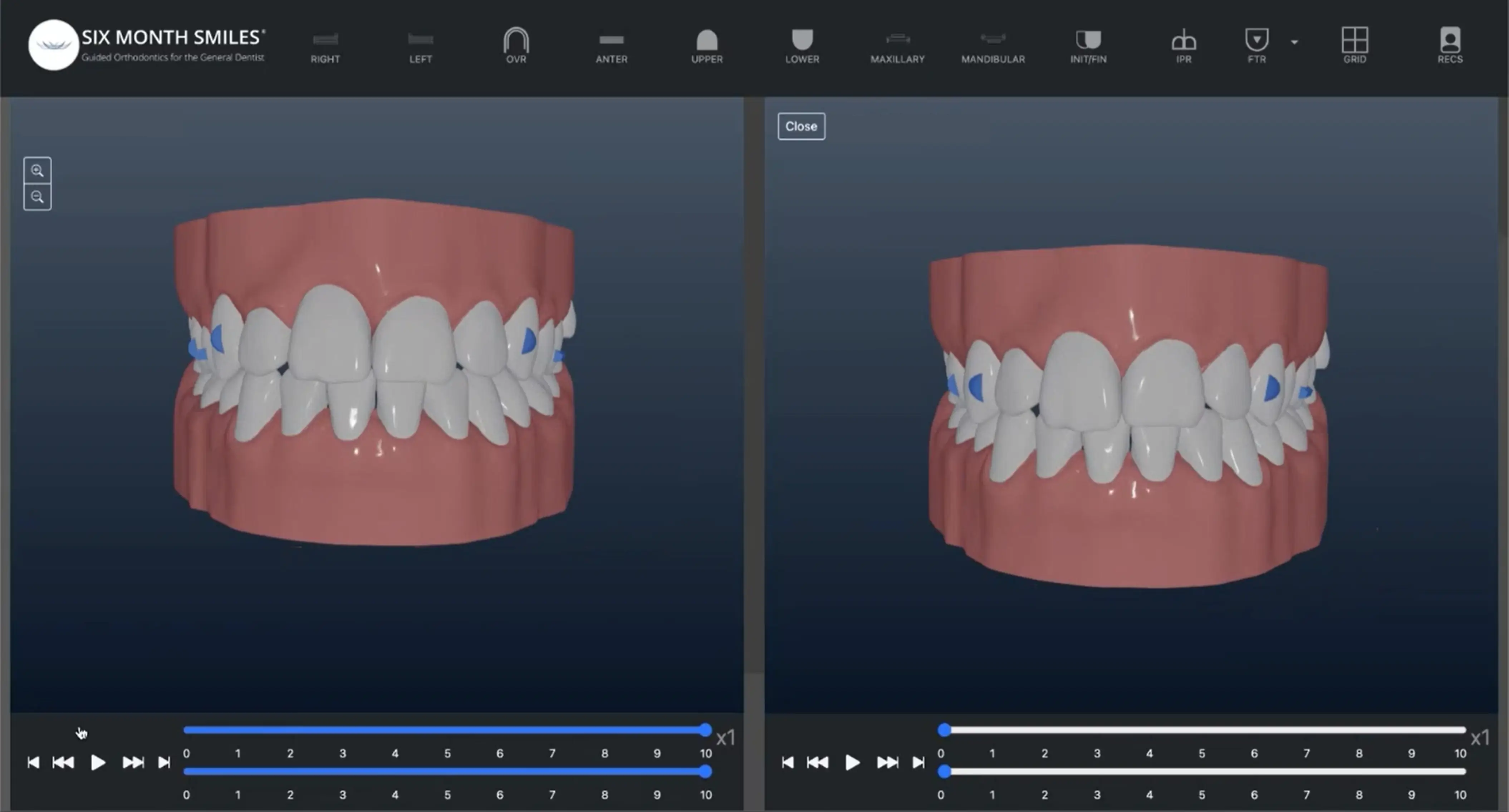 6MS Confidex Aligners_sm