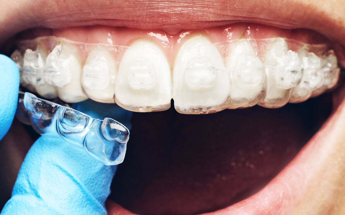 Orthodontics for the General Dentist 